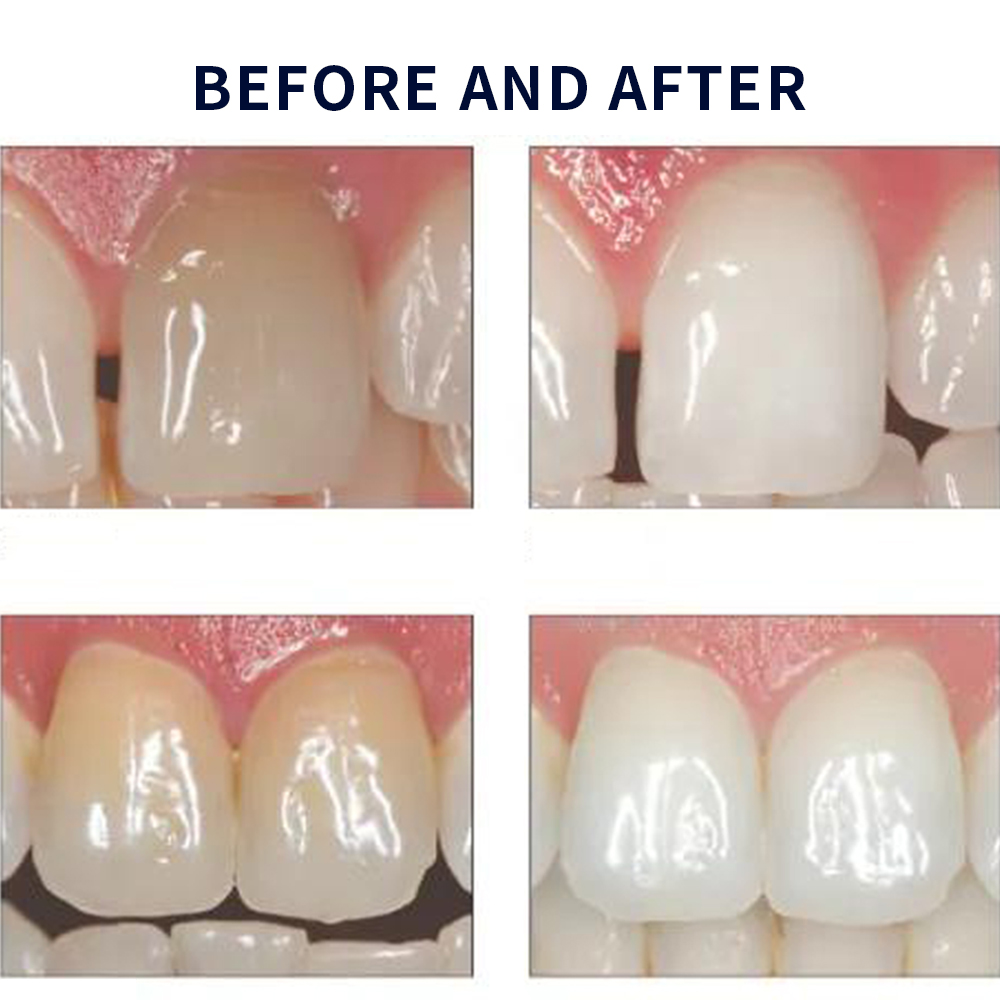 Opalescence Whitening 20% PF 2 - đánh giá và giá Teeth Whitening Home Kit