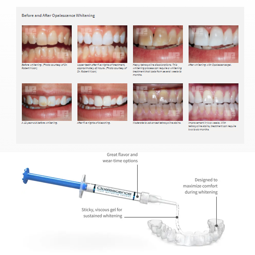 Opalescence Whitening 20% PF 2 - đánh giá và giá Teeth Whitening Home Kit