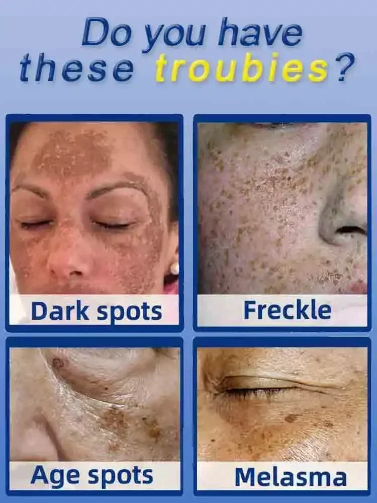 Dark Spot Remover for Face Rem - đánh giá và giá Charcoal Whitening Paste