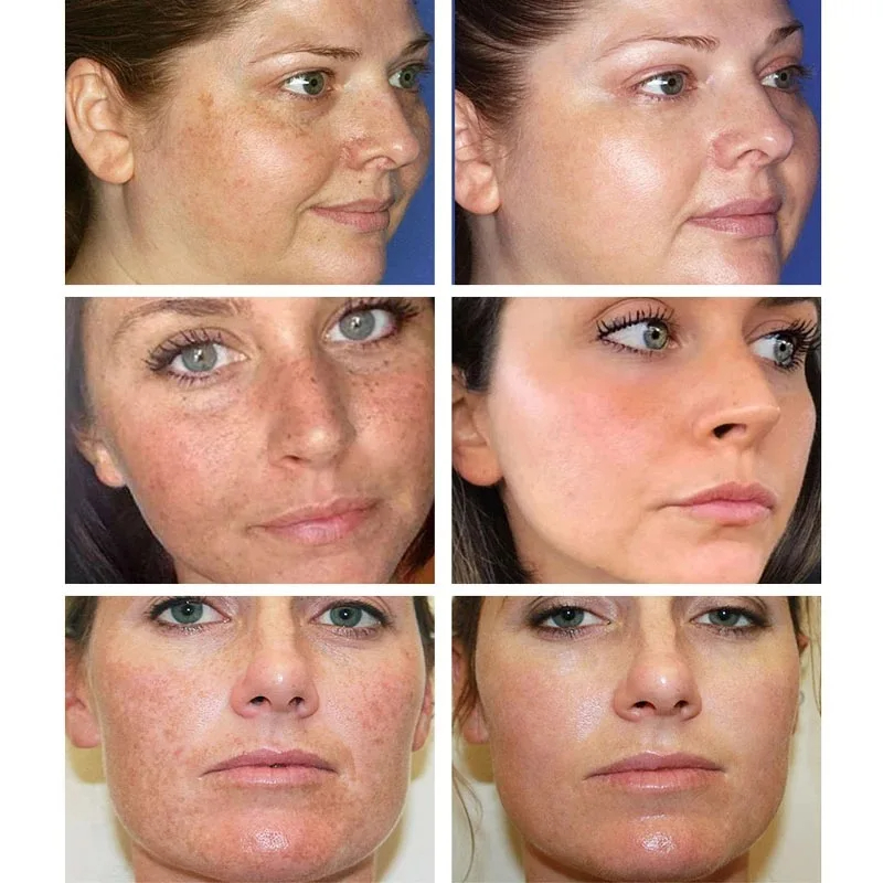 Whitening Freckle Cream Remove - đánh giá và giá Charcoal Whitening Paste